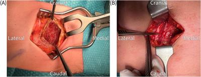 Long-Term Efficacy of Posterior Neurectomy in Anterior Cutaneous Nerve Entrapment Syndrome